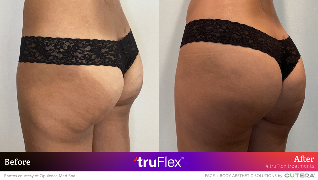01 truSculpt flex BA Opulence